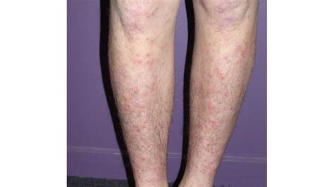 White Spots On Legs Offers Sale Save 42 Jlcatjgobmx