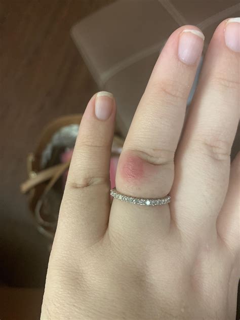 Have Had This Bump On My Finger For A Few Days Its Gotten More Red