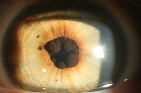 Figure Central Iris Pigment Epithelium Cysts Contributed By Jay