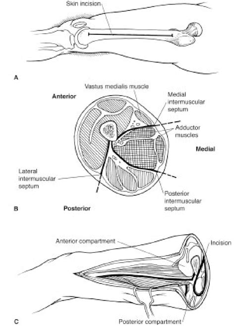 Figure From Chronic Exertional Compartment Syndrome Semantic Scholar