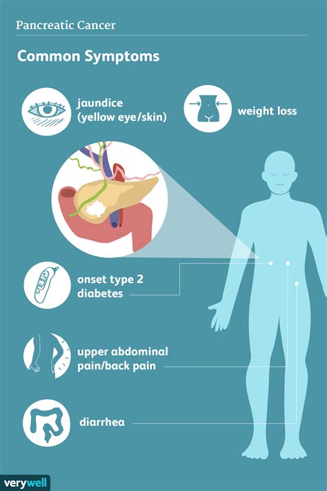 Pancreatic Cancer Signs Symptoms And Complications