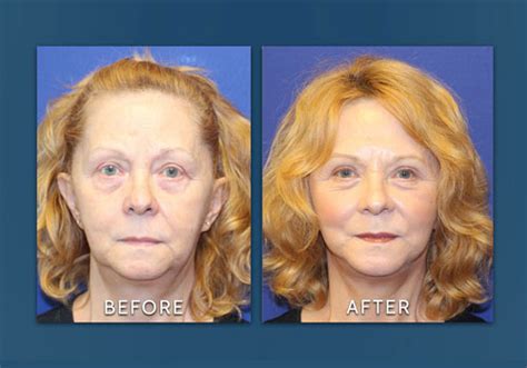 Facelift Surgery And Eyelid Surgery By Dr Amiya Prasad New York