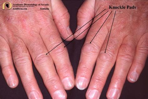 Knuckle Pads Heloderma Academic Dermatology Of Nevada