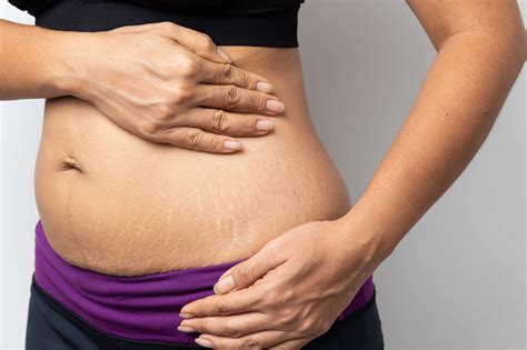 Stretch Marks And Weight Loss Everything You Need To Know Sog Health