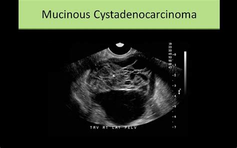 Mucinous Cystadenocarcinoma Ultrasound Sonography Ultrasound