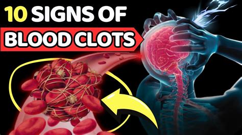 Top 10 Warning Signs Of Blood Clots You Shouldnt Ignore Vitality