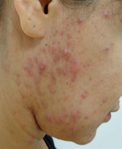 Acd A Z Of Skin Adult Acne