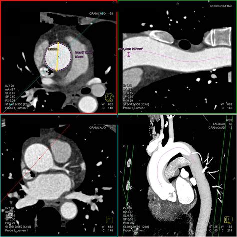 Dilated Aortic Root In Marfan Syndrome Vascular Case Studies Ctisus