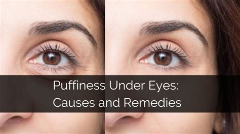 Puffiness Under Eyes Causes And Remedies