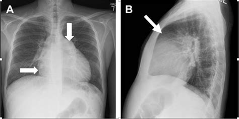 Pulmonary Hypertension Chest X Ray