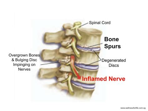 Since the backbone is essentially the back plane or internal switching matrix of the box, proprietary, high performance technology can be used. Wellness for Life Chiropractic | Bones Spurs- Nature's Way To "Save" Your Spine