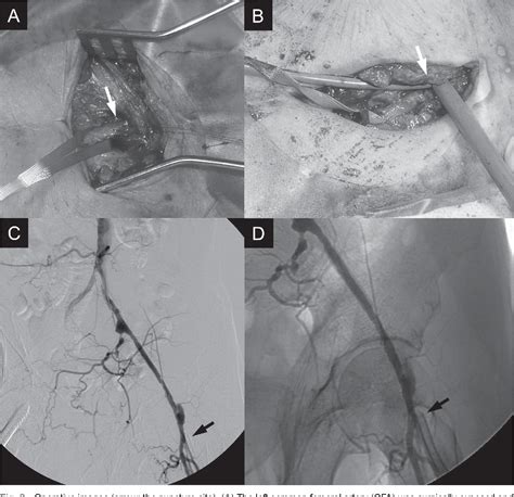 Figure 2 From A Case Of Carotid Artery Stenting Through Surgical