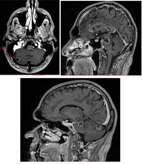 Magnetic Resonance Images Of Metastatic Lesions In The Brainstem And