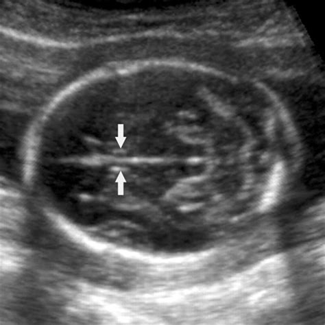 Cavum Septum Pellucidum Fetal Ultrasound