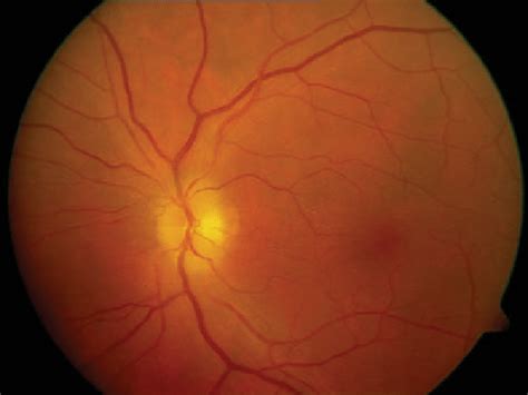 Fundus Photograph Of Pale Optic Disc Edema Associated With Aion