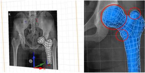 Registration Of The Proximal Femur 3d Model And X Ray Image Based On