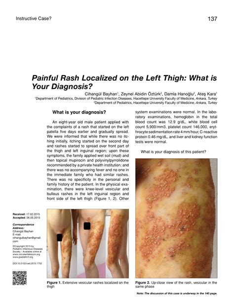 Pdf Painful Rash Localized On The Left Thigh What Is Your Diagnosis