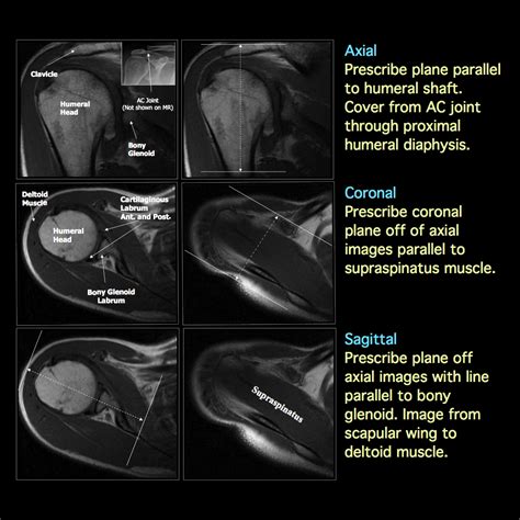 Mri Blog Shoulder Mri