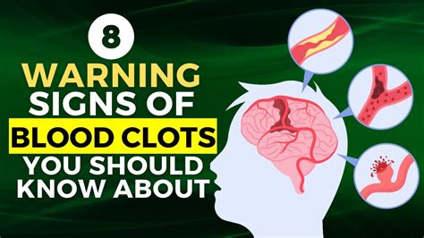 8 Warning Signs Of Blood Clots You Should Know About Youtube
