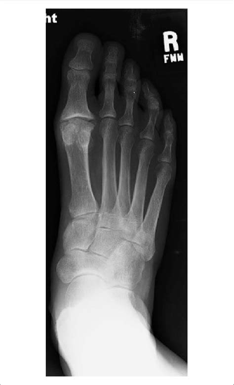 Preoperative Anteroposterior Radiograph Of The Right Foot Download