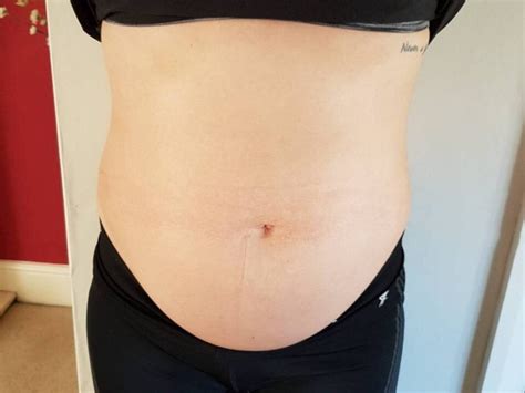 Woman Has Huge Ovarian Cyst Removed After Gym Instructor Asked If Shes Pregnant Real Fix