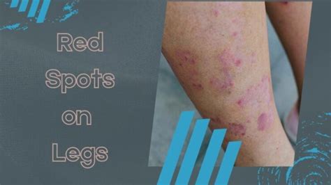 Red Spots On Legs Causes Pictures Including Small Itc