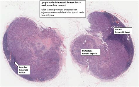 Breast Carcinoma With Lymph Node Metastases Nus Pathweb