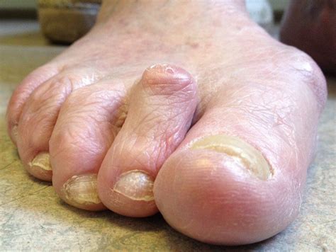 Hammer Toe Deformity Toe Conditions The London Foot And Ankle Clinic