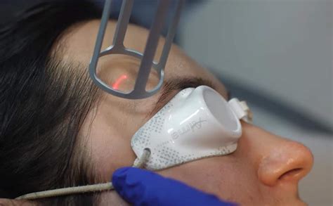 Scheitel Auswandern Verk Rzen Tratament Cu Laser Pentru Semne Acnee