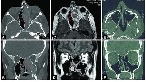 Paranasal Sinuses Preoperative Imaging A Axial Ct Scan View Showing