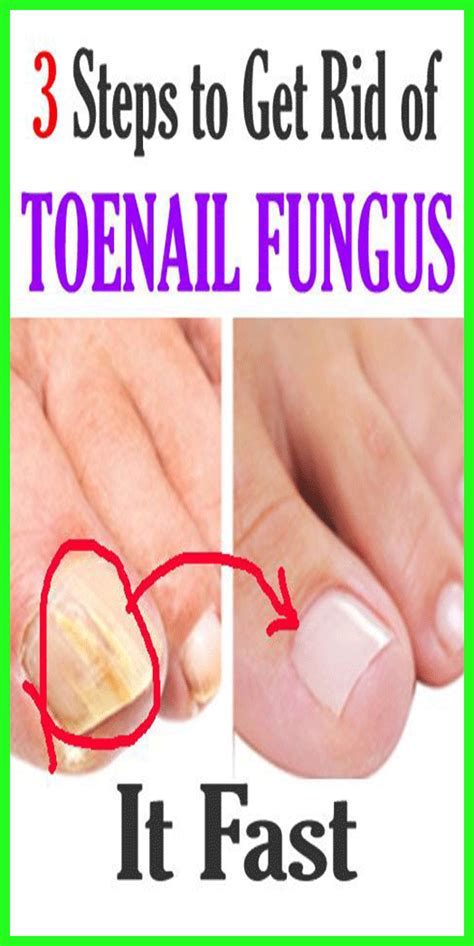 3 Steps To Get Rid Of Toenail Fungus Toenail Fungus Remedies Nail