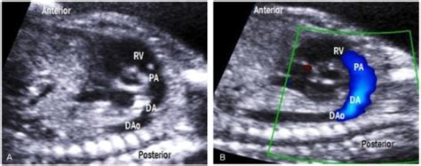 Ductal Arch View A The Ductus Arteriosus Connects Th Open I