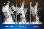 脊柱側彎六年 中醫整脊「正點」！ - - 自由時報電子報