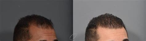 Male Fue Hair Transplant Before After Photos Patient Serving