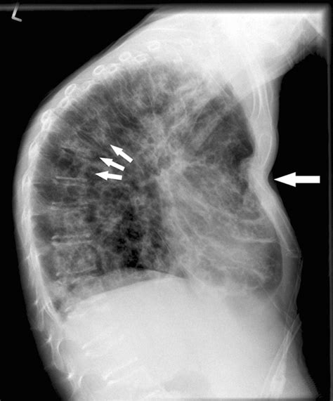 Sternal Fracture With Fatal Outcome In Cystic Fibrosis Latzin Et Al