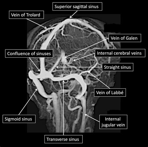Cerebral Venous Thrombosis A Practical Guide Practical Neurology