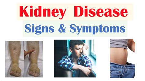 Kidney Renal Disease Signs And Symptoms Ex Peripheral Edema Fatigue