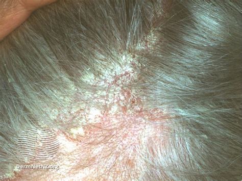 La dermatite atopique sur le cuir chevelu peut ressembler beaucoup à des pellicules ou à du
