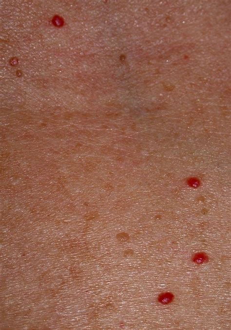 Red Blood Blisters On Skin
