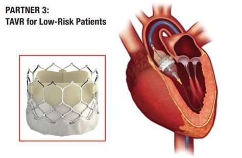 Tavr Branches Out New Refinements Broader Indications Newyork