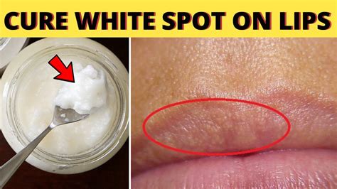 White Spots On Lips