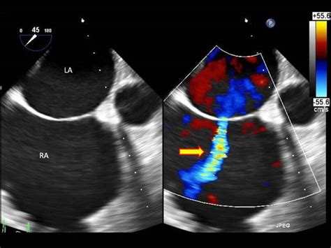 Figure Transesophageal Echocardiography Image Showing The