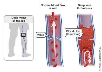 Blood clotting, or coagulation, is an important process that prevents excessive bleeding when a blood vessel is injured. DVT - DVT (disambiguation) - JapaneseClass.jp