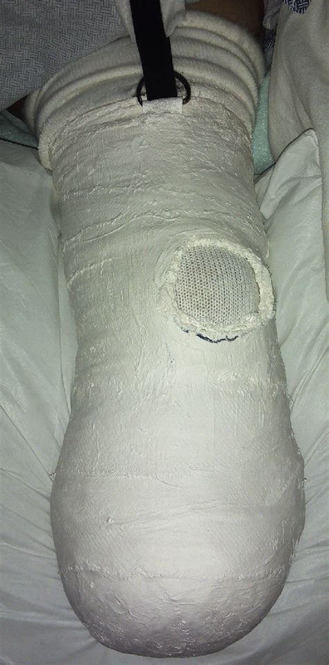 Hard Cast Placed Immediately After Below Knee Amputation In The