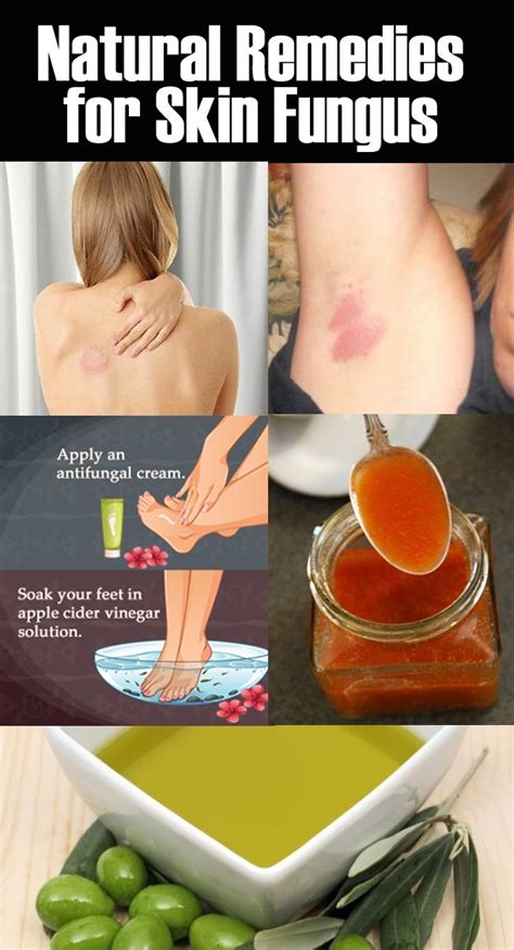 Speedy Home Remedies For Skin Fungus Home Remedies For Skin Remedies