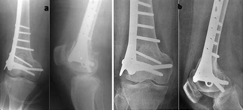 Femoral Supracondylar Focal Dome Osteotomy With Plate Fixation For