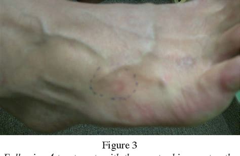Pdf Ganglion Cyst Of The Foot Treated With Electroacupuncture A Case