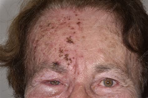 Shingles Rash Affecting Facial Nerve Stock Image C0473044