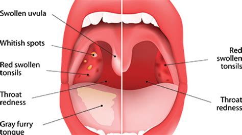 Chronic Disease Of Tonsils And Adenoids Adalah