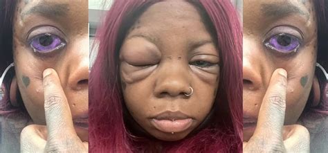 Mother Of Five Going Blind After Tattooing Her Eyeball Purple